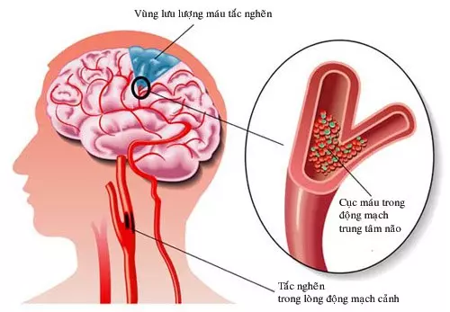 KHÔNG BAO GIỜ LÀ SỚM KHI PHÒNG TRÁNH THIỂU NĂNG TUẦN HOÀN NÃO