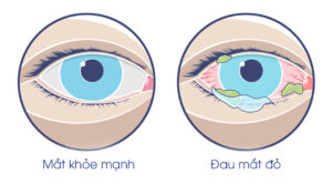 Cách phòng bệnh đau mắt đỏ hiệu quả