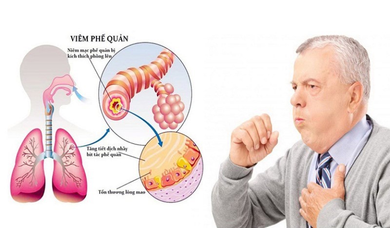 TRIỆU CHỨNG VÀ CÁCH ĐIỀU TRỊ VIÊM PHẾ QUẢN