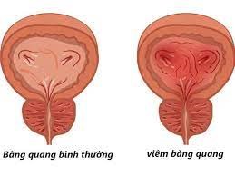 VIÊM BÀNG QUANG NGUYÊN NHÂN VÀ CÁCH PHÒNG NGỪA