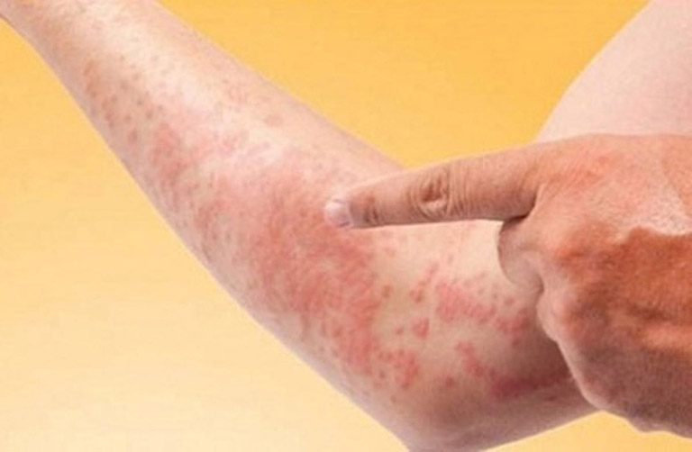 CÁC LOẠI THỰC PHẨM DỄ GÂY DỊ ỨNG