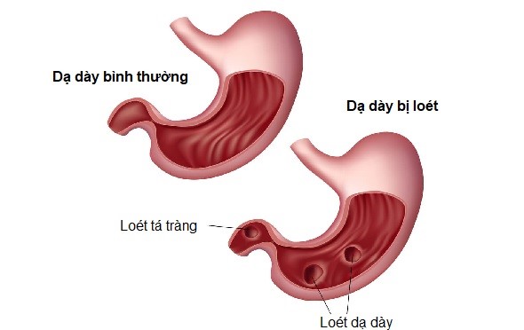 VIÊM LOÉT DẠ DÀY – NGUYÊN NHÂN, TRIỆU CHỨNG