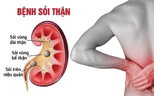 CÁC THÓI QUEN ÂM THẦM GÂY SỎI THẬN