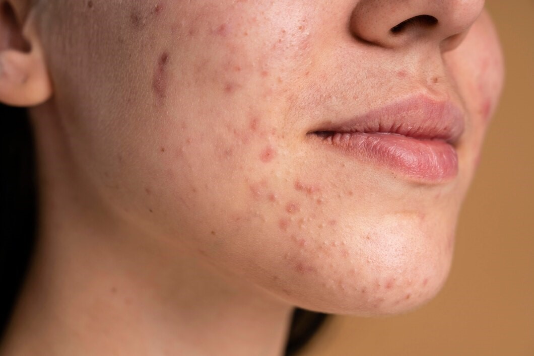 LÀM THẾ NÀO ĐỂ NGĂN NGỪA SẸO MỤN HIỆU QUẢ