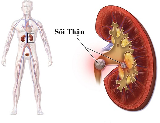 4 LOẠI NƯỚC GIÚP ĐÀO THẢI SỎI THẬN