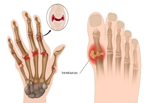 CÁC MÓN ĂN GIÚP KIỂM SOÁT ACID URIC, PHÒNG NGỪA BỆNH GOUT