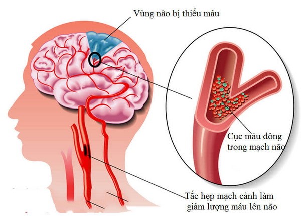 THIẾU MÁU NÃO NÊN UỐNG GÌ VÀ CÁCH PHÒNG NGỪA