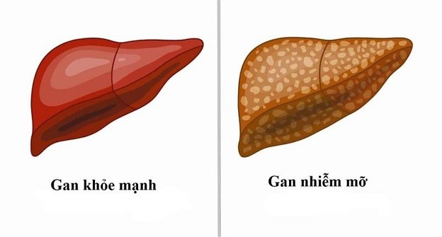 NHỮNG THỰC PHẨN NÊN ĂN VÀ KHÔNG NÊN ĂN CHO NGƯỜI BỊ GAN NHIỄM MỠ