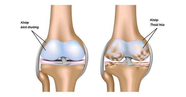 CÁCH BẢO VỆ NGĂN NGỪA THOÁI HÓA KHỚP