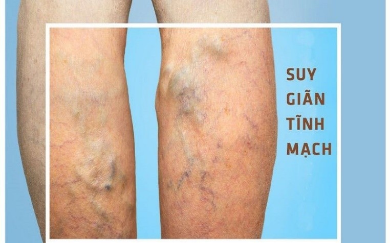BIẾN CHỨNG VÀ CÁCH PHÒNG NGỪA BỆNH SUY GIẢM TĨNH MẠCH