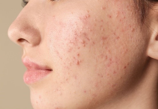 NGUYÊN NHÂN GÂY RA MỤN VÀ CÁCH ĐIỀU TRỊ MỤN