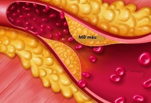 NHỮNG QUAN ĐIỂM SAI LẦM VỀ MỠ MÁU
