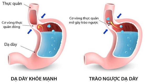 TRÀO NGƯỢC DẠ DÀY GÂY HÔI MIỆNG