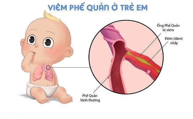 VIÊM TIỂU PHẾ QUẢN Ở TRẺ