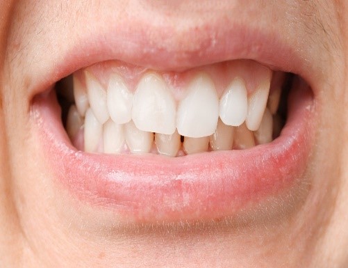CÁC THÓI QUEN LÀM HẠI MEN RĂNG THƯỜNG GẶP